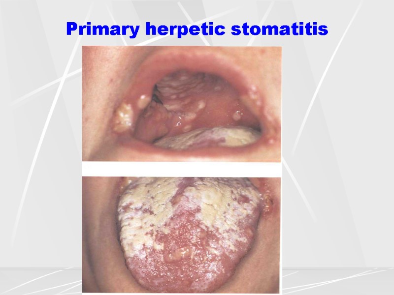 Primary herpetic stomatitis